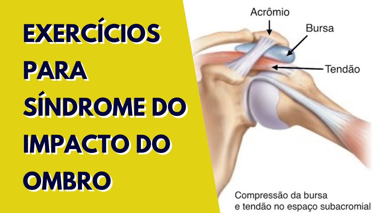 EXERCÍCIOS PRA SÍNDROME DO IMPACTO DE OMBRO