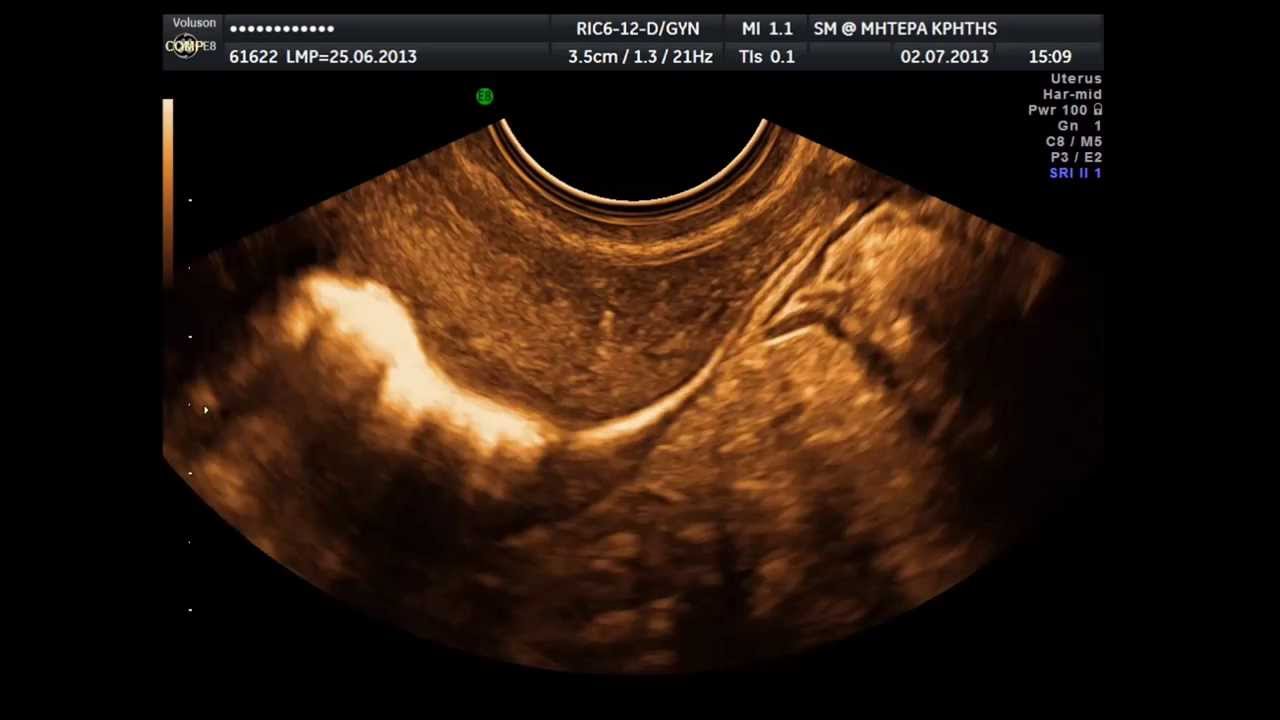 Hysterosalpingo-Contrast Sonography HyCoSy -- normal study