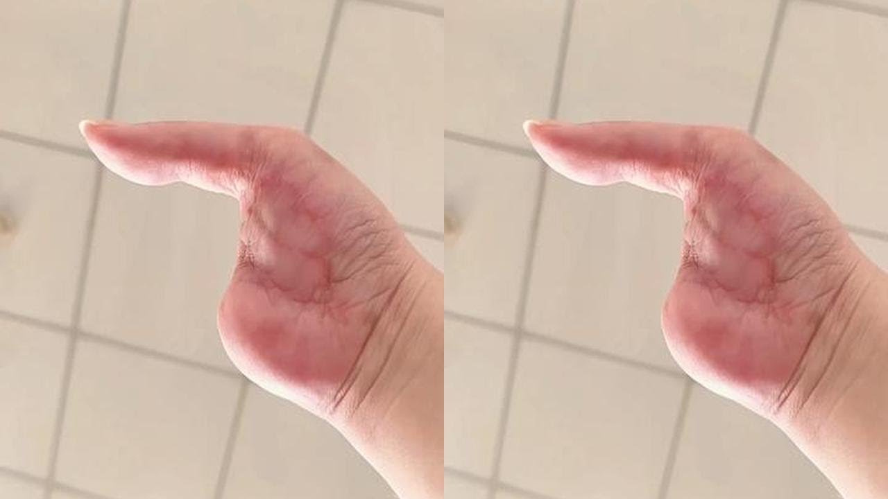 It can be indistinguishable from the real thing #Aesthetic Silicone Fingers #Finger Missing