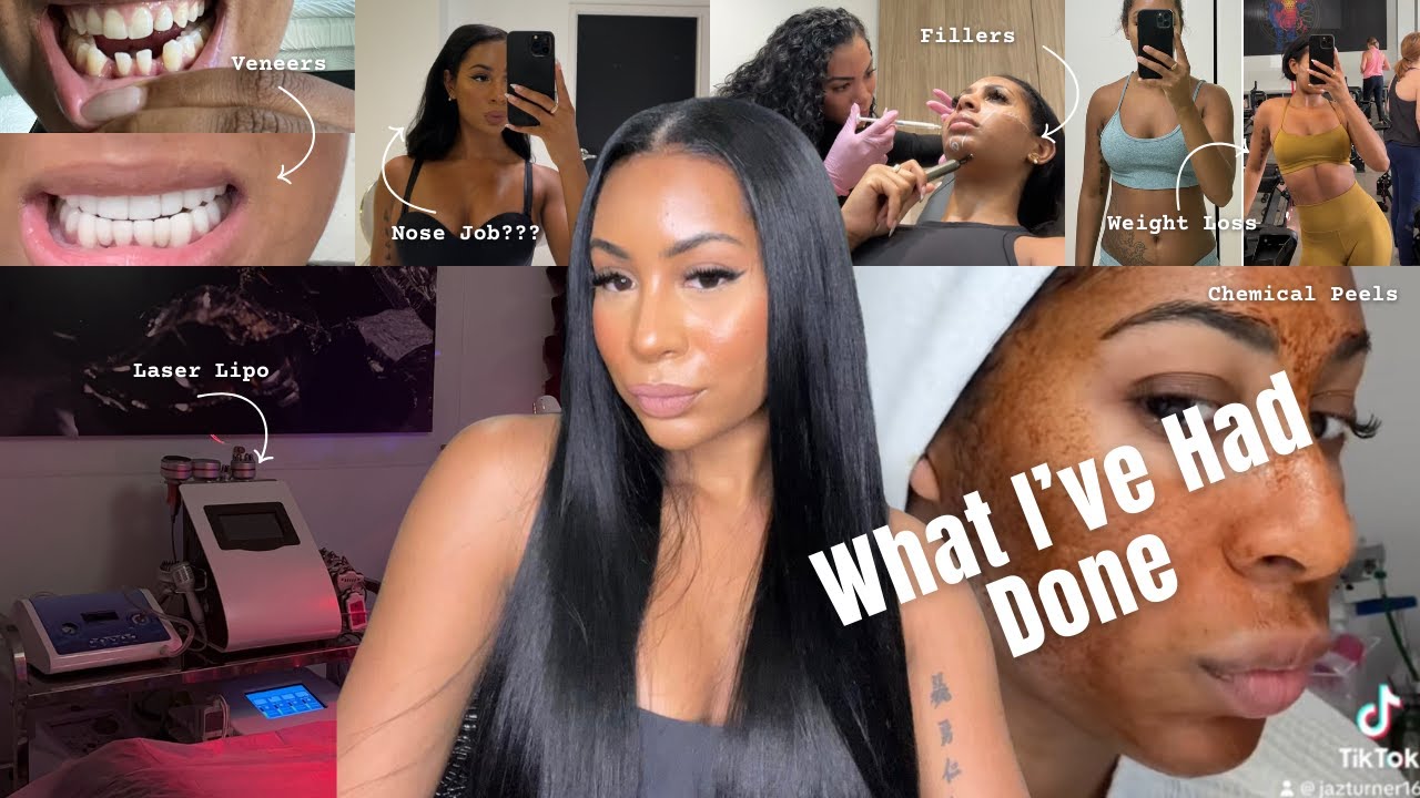 WHAT I'VE HAD DONE | fillers, botox, veneers, nose job?? //honest + real af//