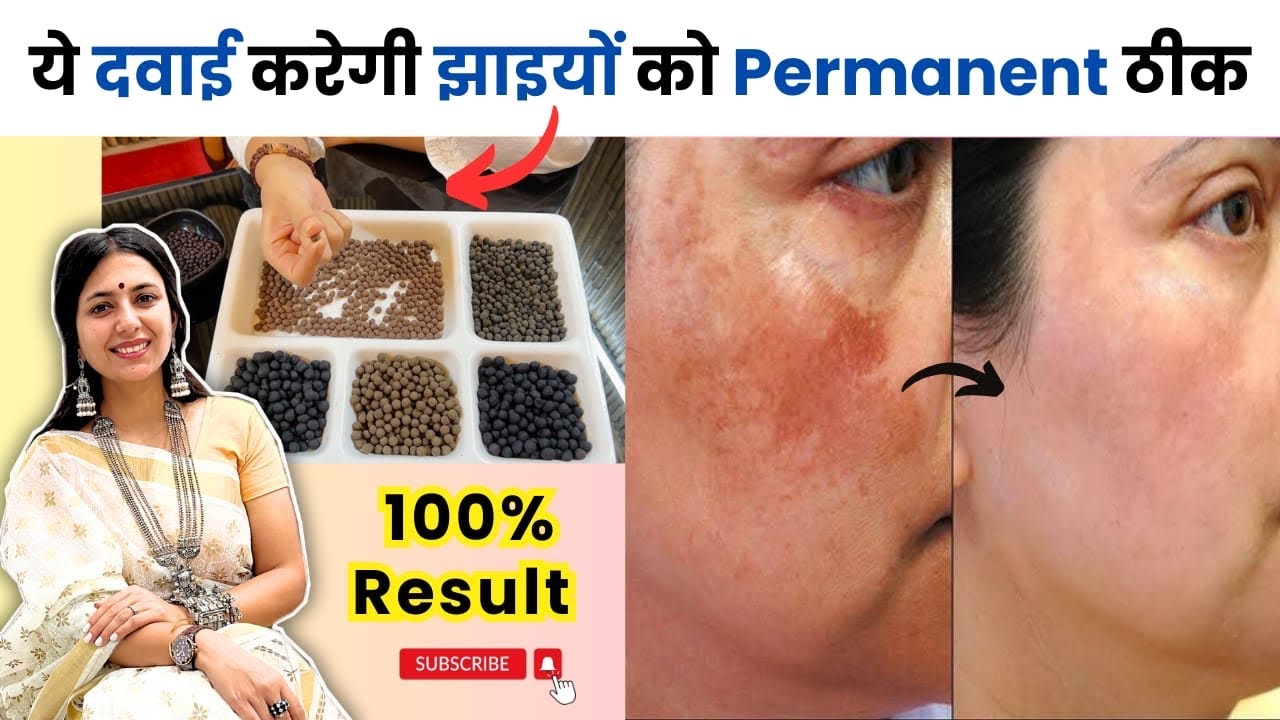 दुनिया की इकलौती दवाई जो झाइयों को ठीक करेगी | How to remove Melasma Permanently | Dr. Upasana Vohra