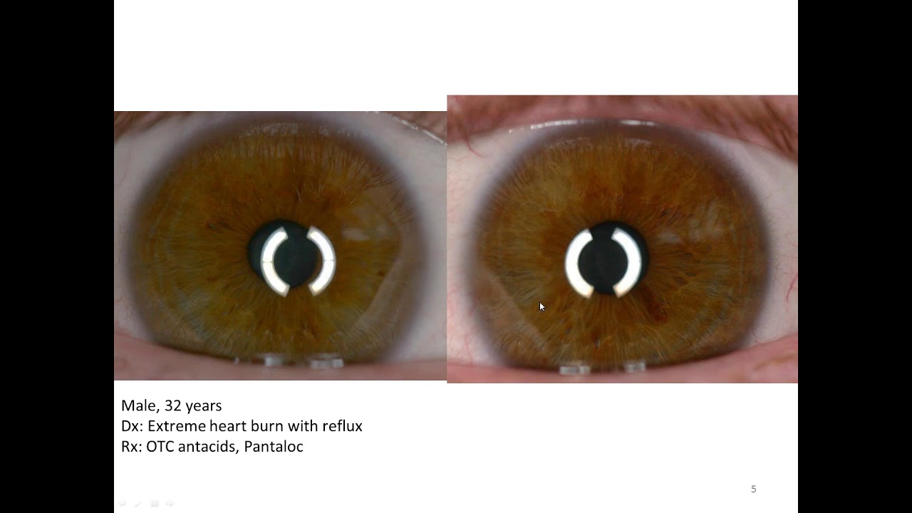 Dynamic Iridology - Digestive System Case studies