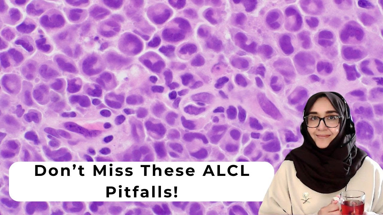 Pathology of Anaplastic Large Cell Lymphoma: Key Diagnostic Features and Pitfalls