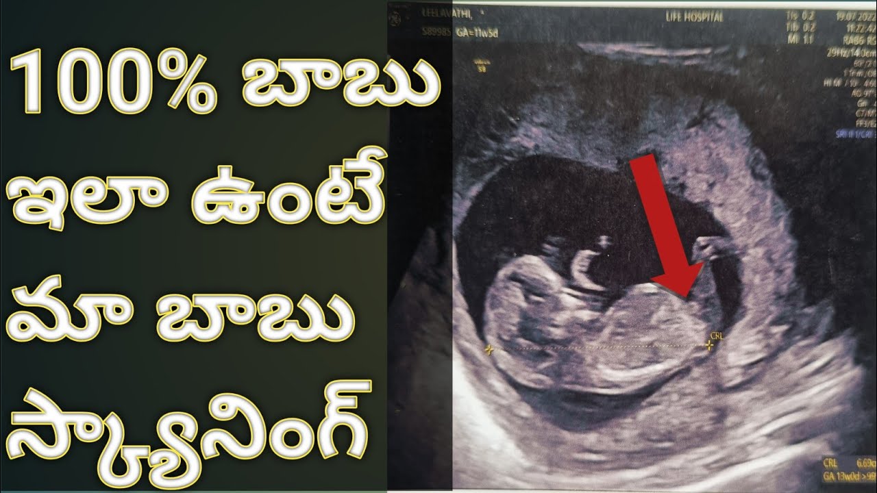 My baby boy scanning reports ఈ విధంగా ఉంటే 100% బాబూ నే పడతాడు anterior position full information 