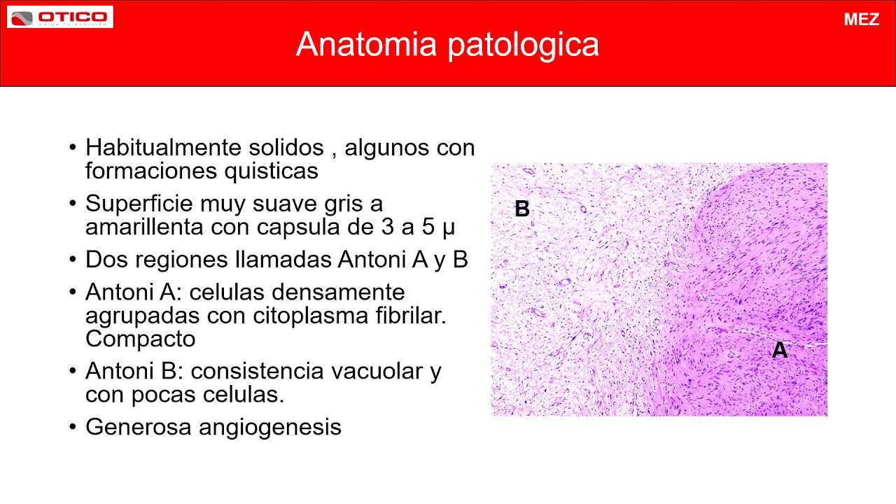 NEURINOMA DEL ACUSTICO