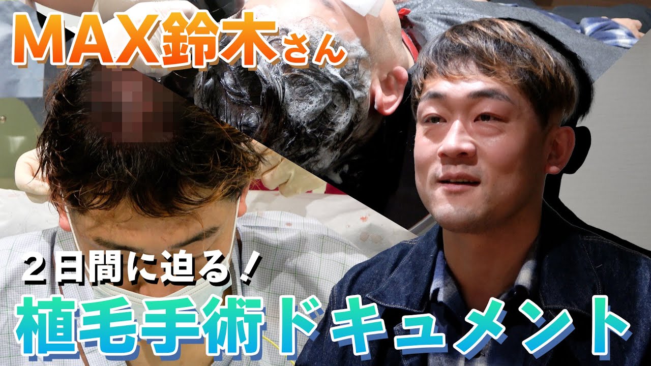 【自毛植毛】MAX鈴木さんの2度目の自毛植毛に密着しました！