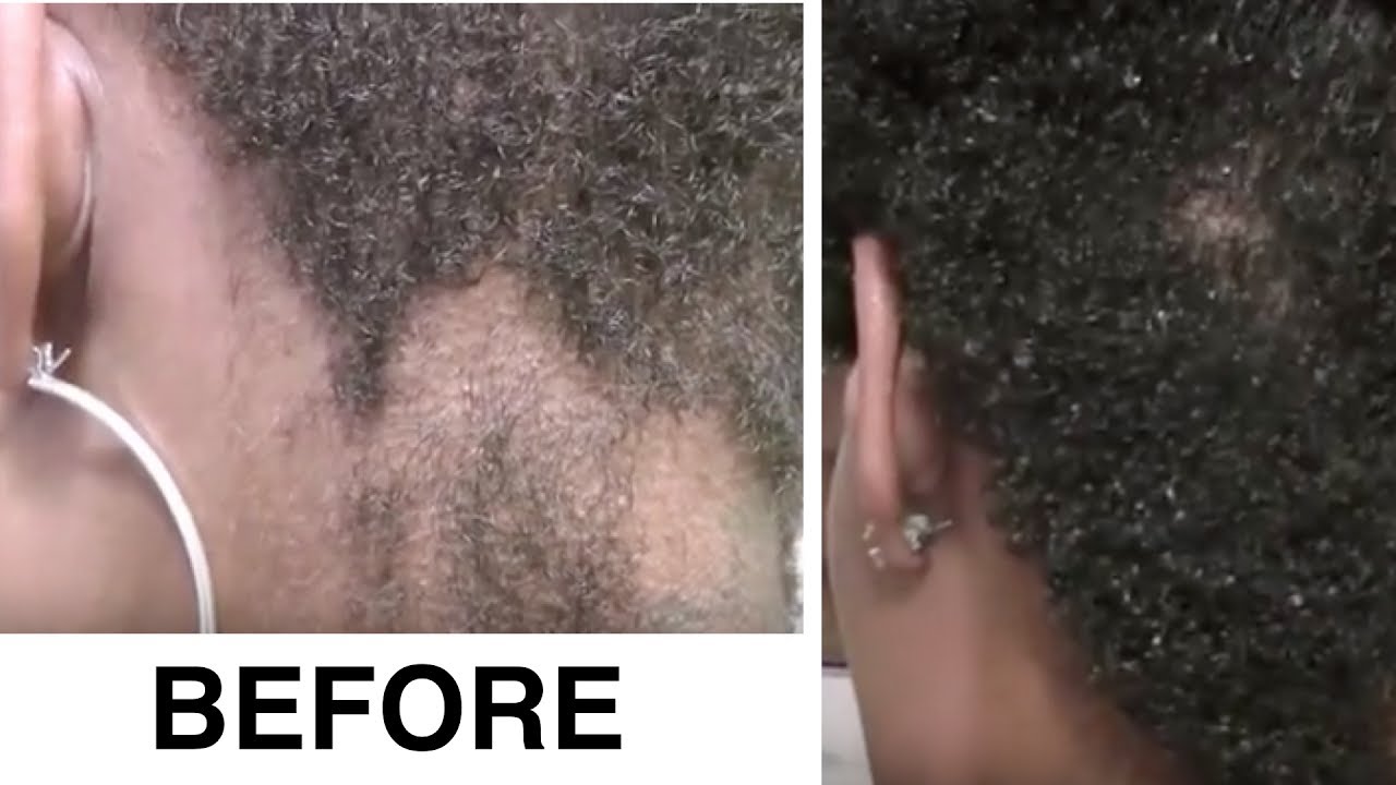 Signs of New Hair Growth - Regrow Bald Spots & Alopecia (2017)