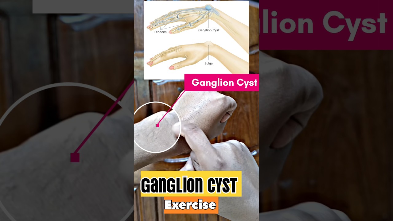 Ganglion Cyst Exercise #physiotherapy #exercise #help #treatment #wristpain