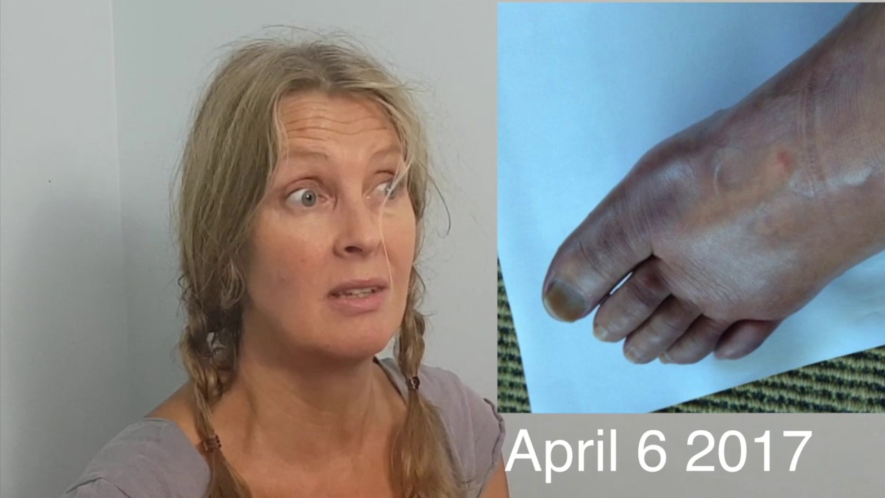 physiokey Case Study: Reflex Sympathetic Dystrophy