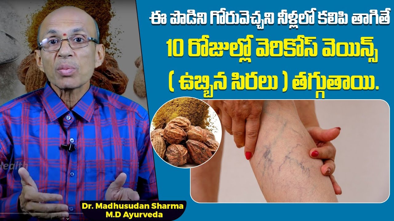 ఉబ్బిన సిరలకు ఇంటి చిట్కా | Varicose Veins Ayurvedic Treatment Telugu | Dr C Madhusudhan Sharma