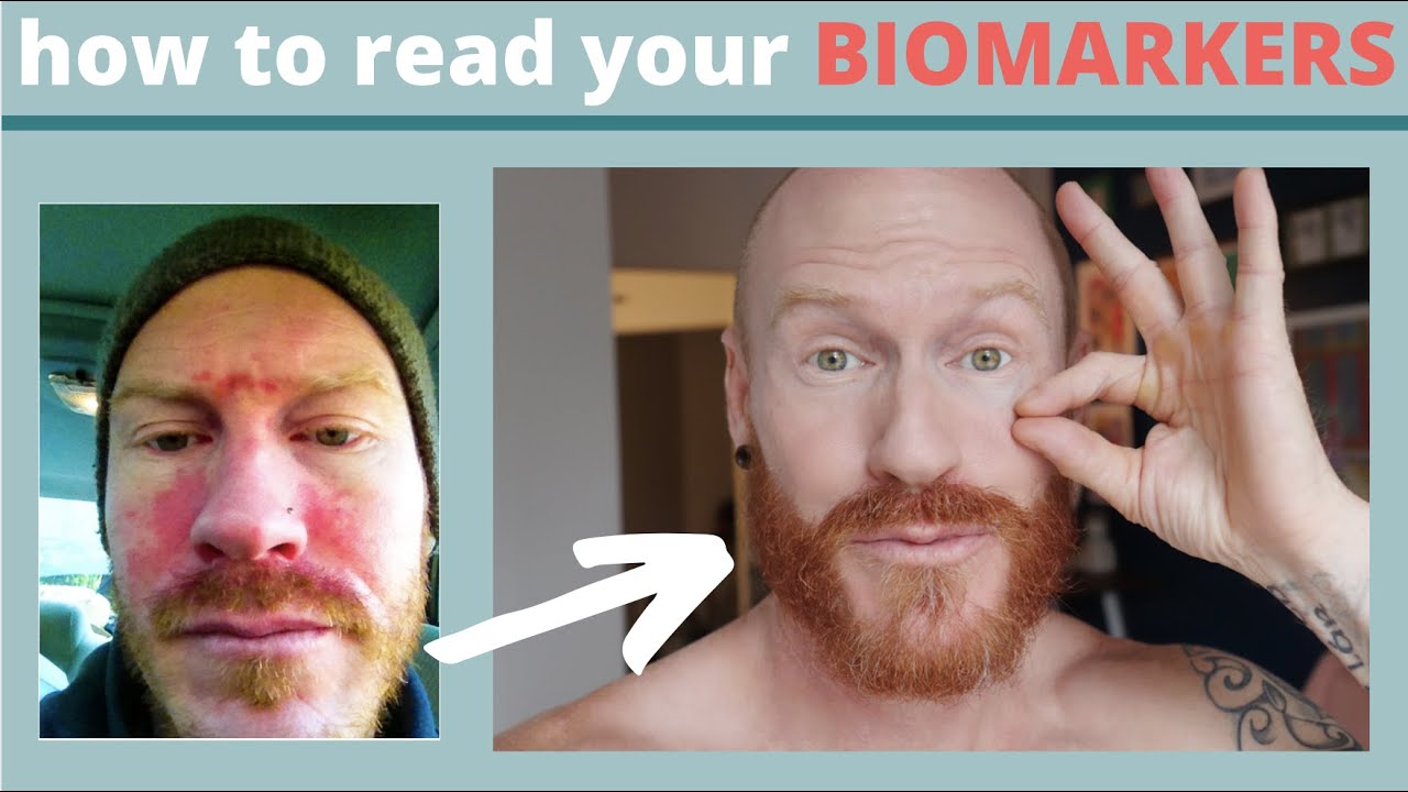 How To Read your BIOMARKERS: the Key to customizing your DIET and HEALING your Skin