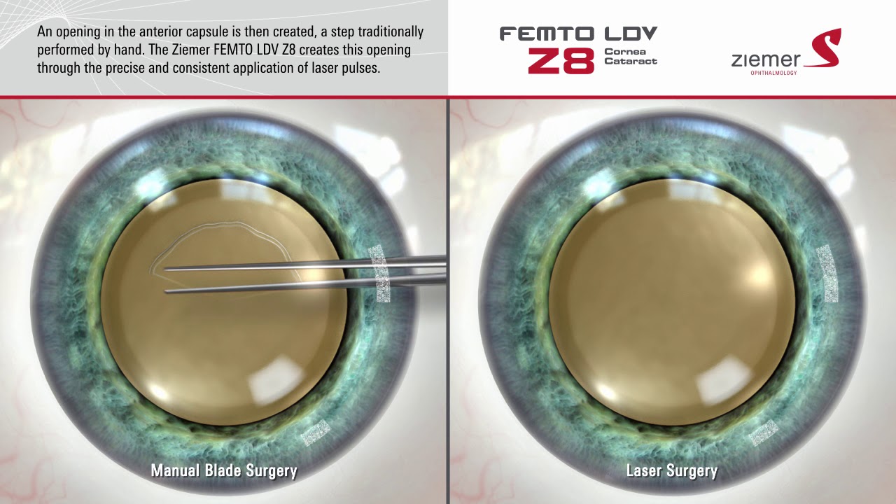 Ziemer Z8 Laser Procedure