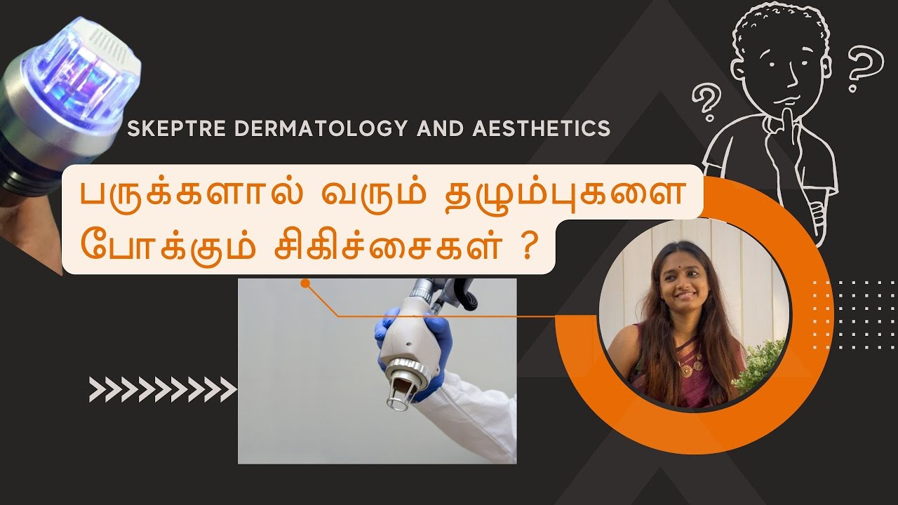 பருக்களால் வரும் தழும்புகளை போக்கும் சிகிச்சைகள் | ACNESCAR | TCACROSS | HASHTAGDRARCHANA | SKEPTRE