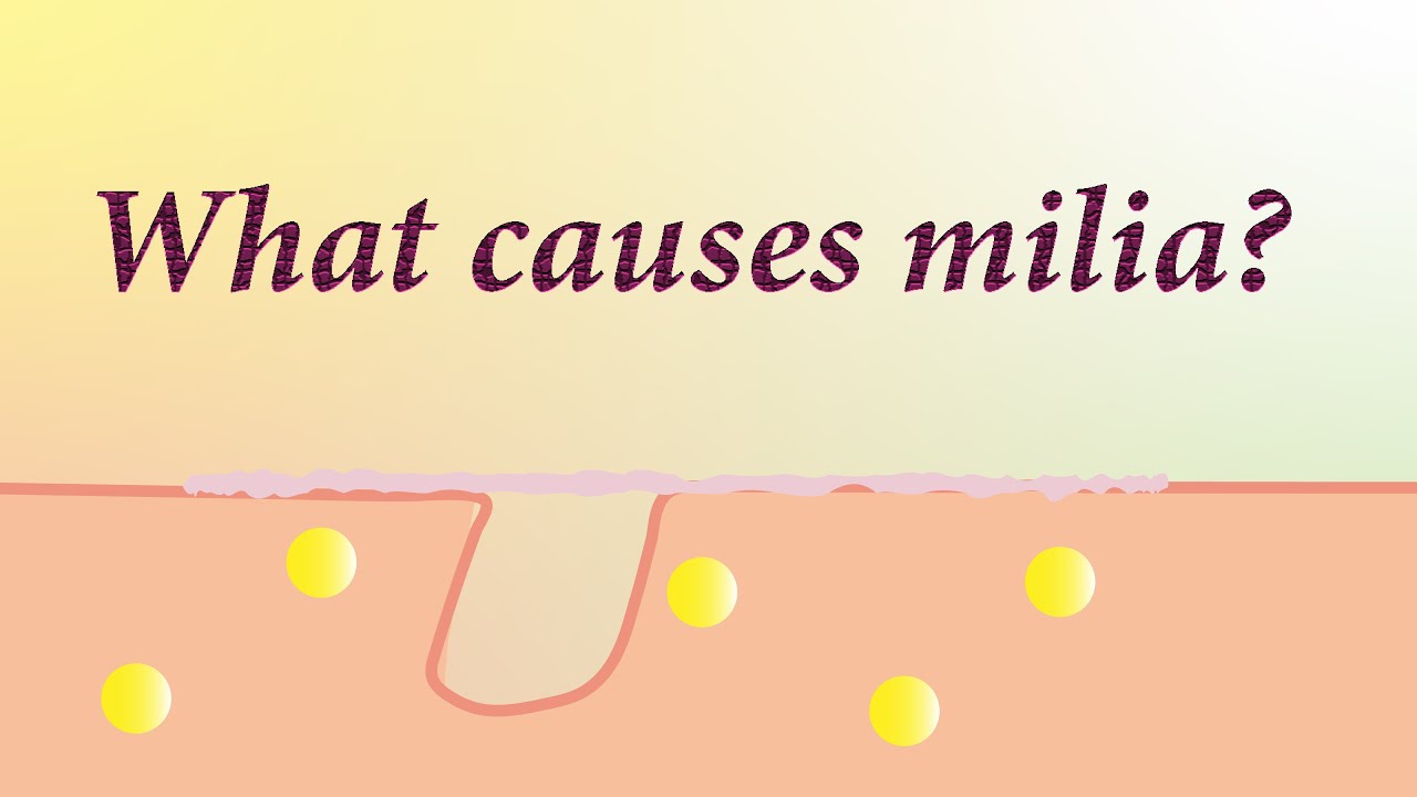 what causes milia ?
