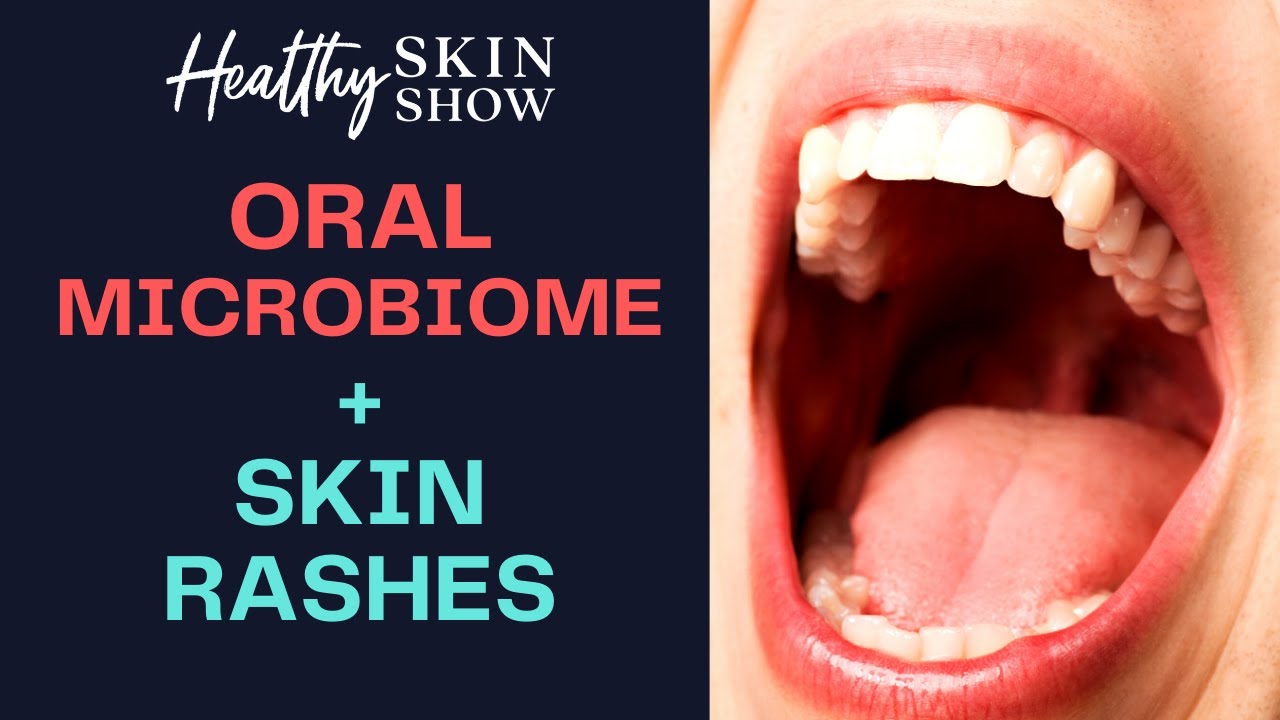 ORAL Microbiome-Skin Rash Connection | Dr. Mark Burhenne