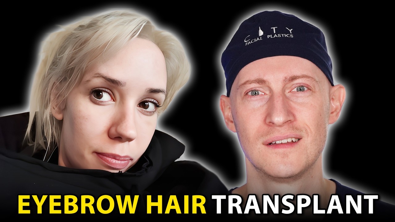 INCREDIBLE Eyebrow Hair Transplant Results