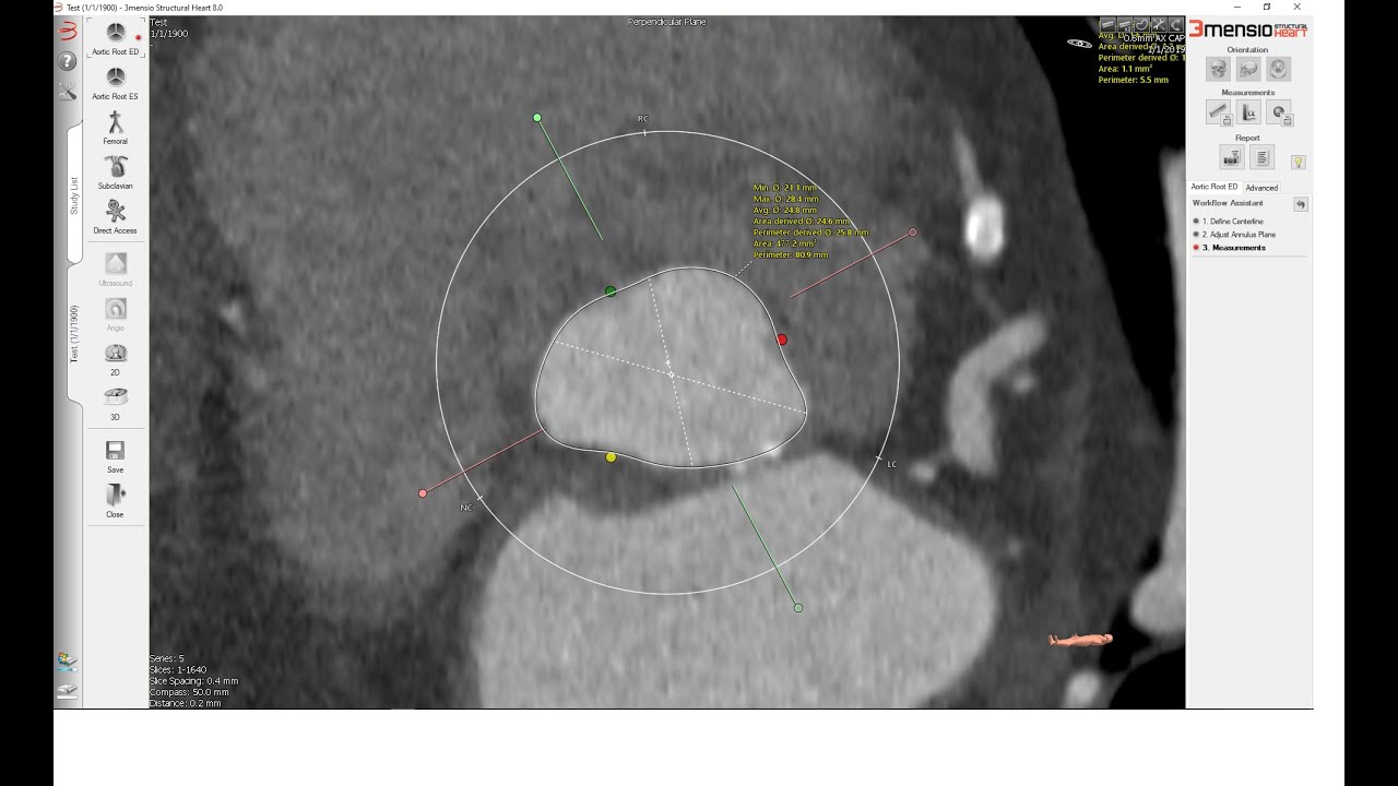 Sizing the Aortic Valve Annulus   3Mensio