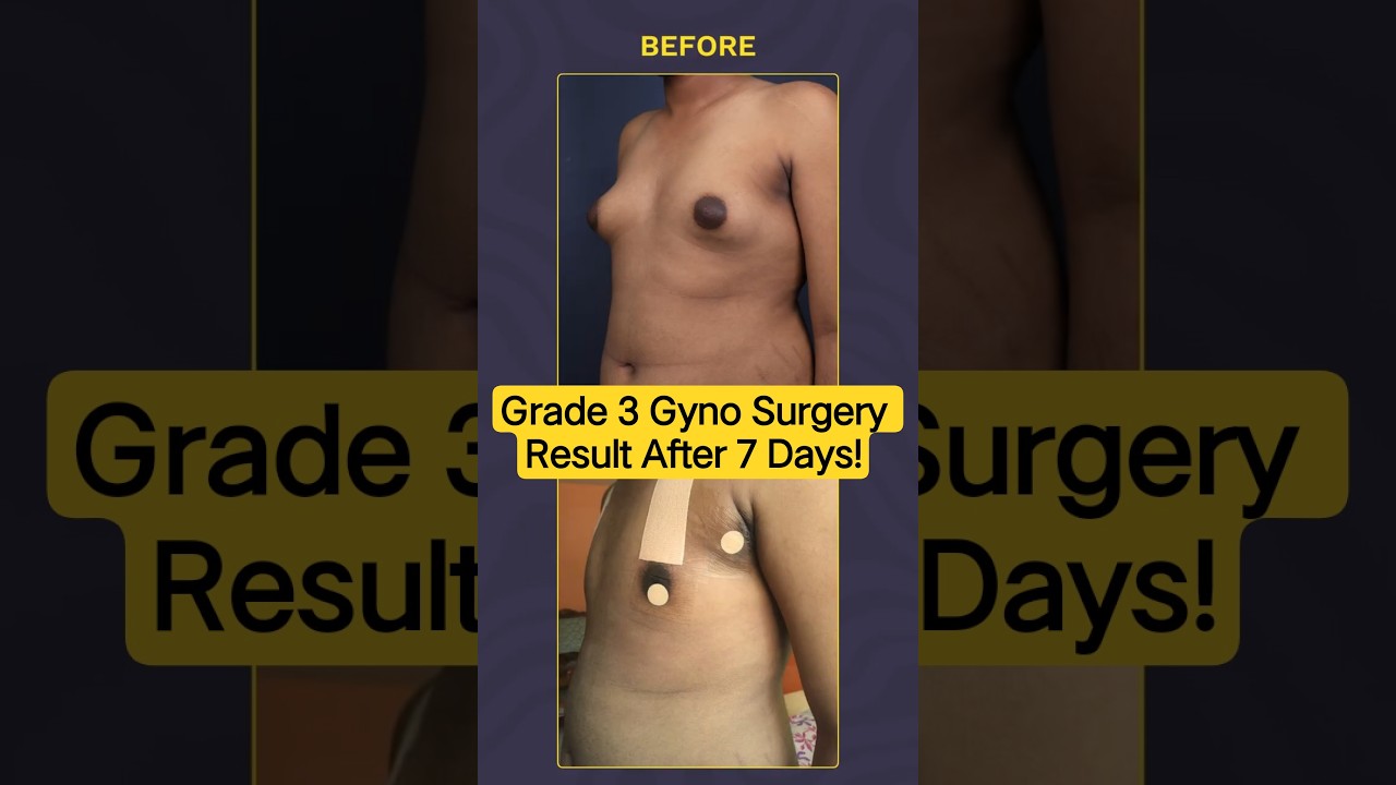 Grade 3 Gynecomastia Surgery Result After 7 Days! | Dr DC, Plastic Surgeon | India