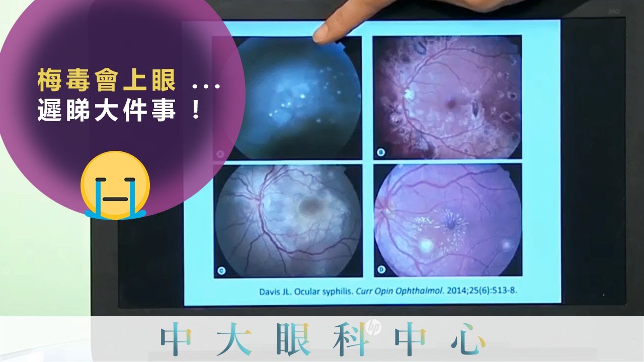中大眼科 x 開電視：梅毒會上眼？遲睇大件事！