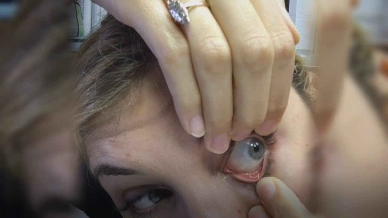 Les bonnes manières pour mettre et enlever ses lentilles