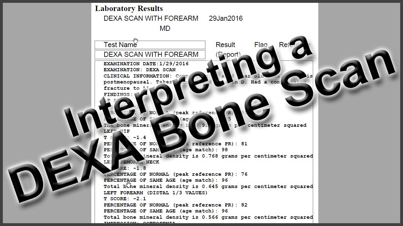 Interpreting a DEXA Bone Scan