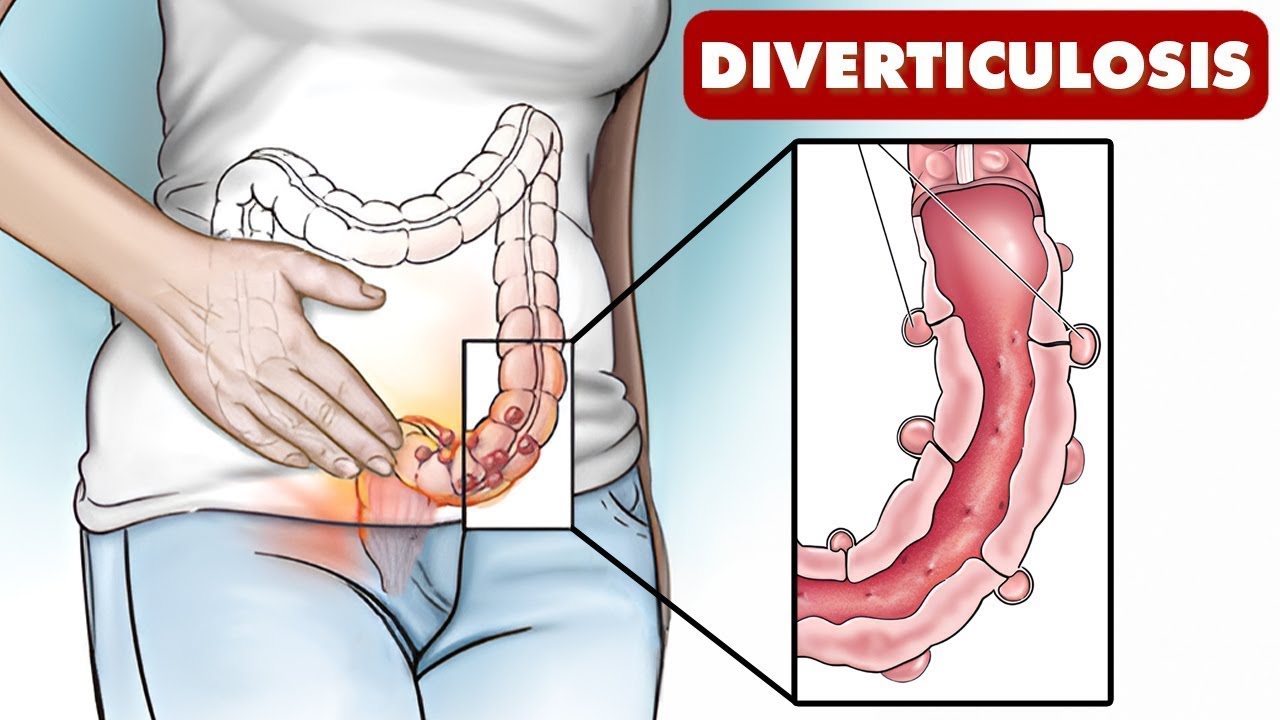 6 Signs of Diverticulitis You Should NEVER Ignore!