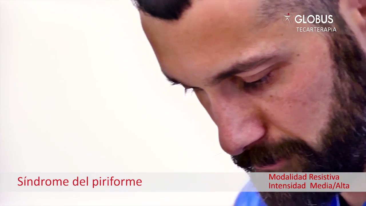 Diatermia: Tratamiento del Síndrome del piriforme con el equipo de DiaCare 5000