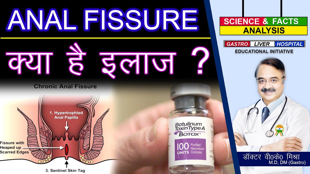 ANAL FISSURE क्या है इलाज ? || ANAL FISSURE. DIAGNOSIS AND TREATMENT