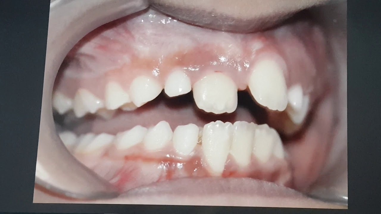 العلاج المبكر والسريع للاطباق المعكوس (سبعة ايام فقط)(Early& Rapped treat on incisor crossb 7 day)d