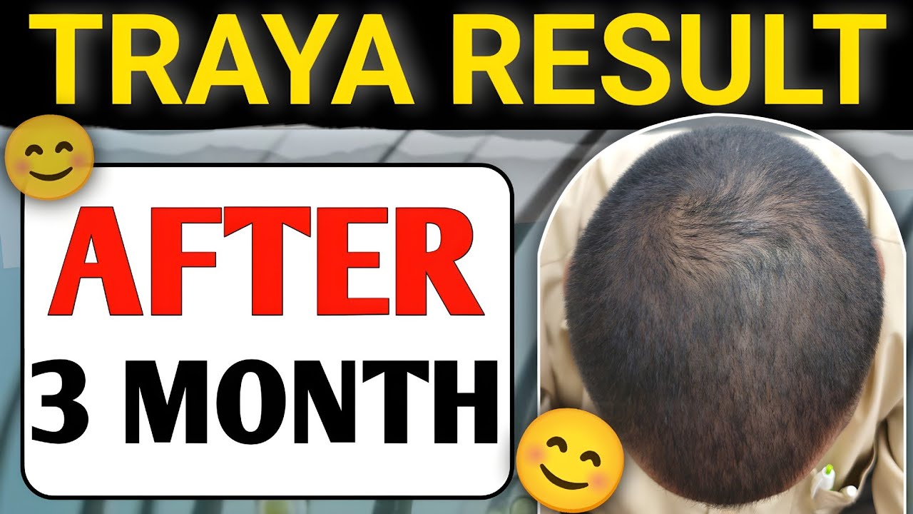 Traya Result After 3 Month | Hair Regrowth Journey 