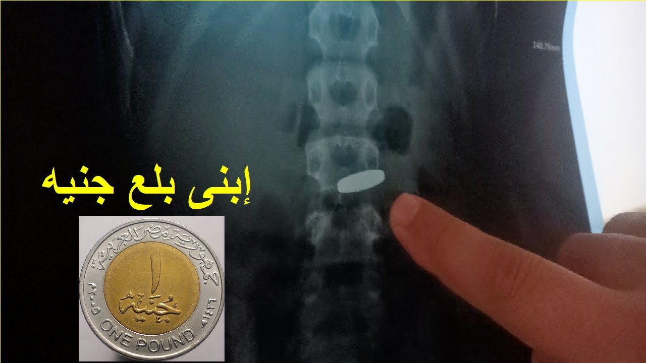 ابنى بلع جنيه !! شوف احنا عملنا ايه