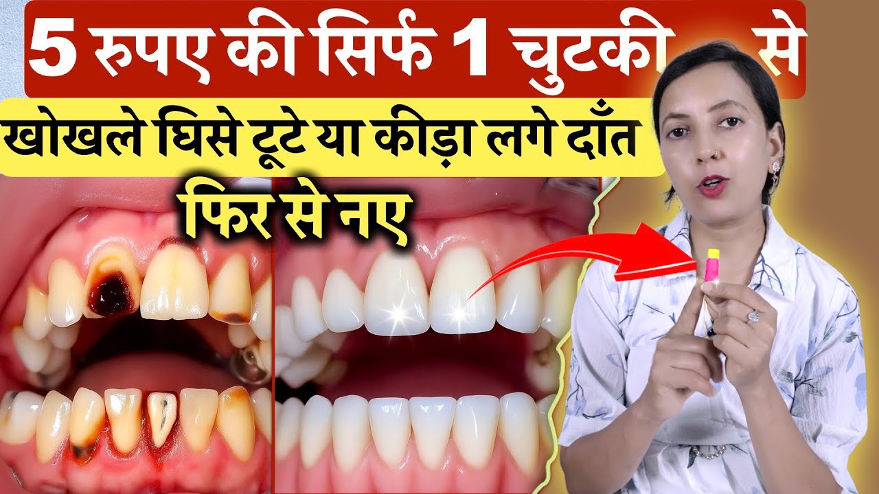5 रुपये की सिर्फ़ 1 चुटकी से दाँत में कीड़ा, दाँत घिसना या टूटना, खोखला दाँत फिर से नए |Teeth