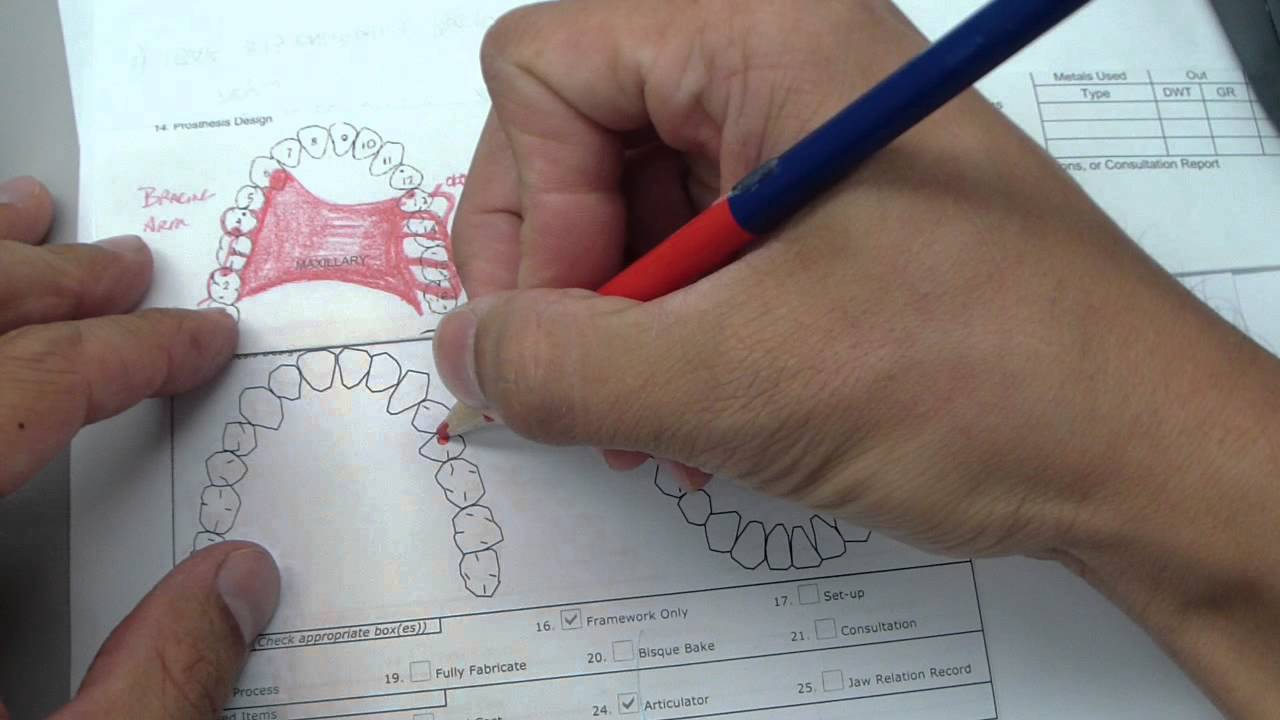Removable Partial Denture - Reviewing design and how to draw