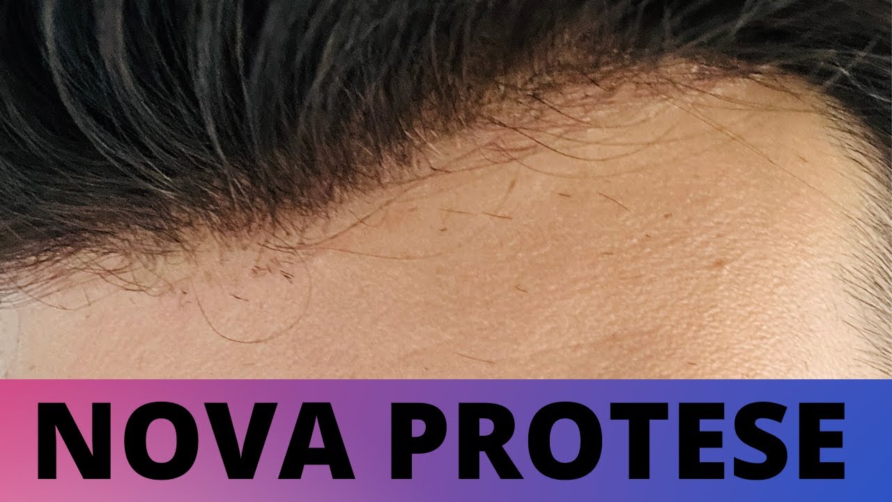 DICAS + PROTESE NOVA NATURALIDADE SURREAL  |#PROTESECAPILARMASCULINA|@JADSON.ANDRESEN