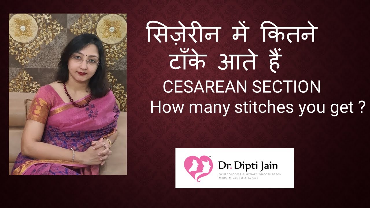 सिज़ेरीन में कितने टाँके आते हैं / CESAREAN SECTION - How many stitches you get ?