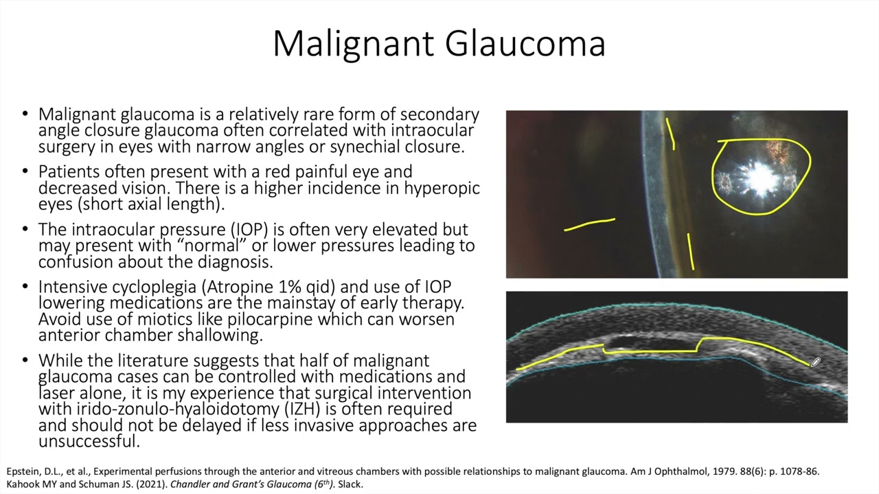 Lecture: Malignant Glaucoma (1 Slide in 5 Minutes)