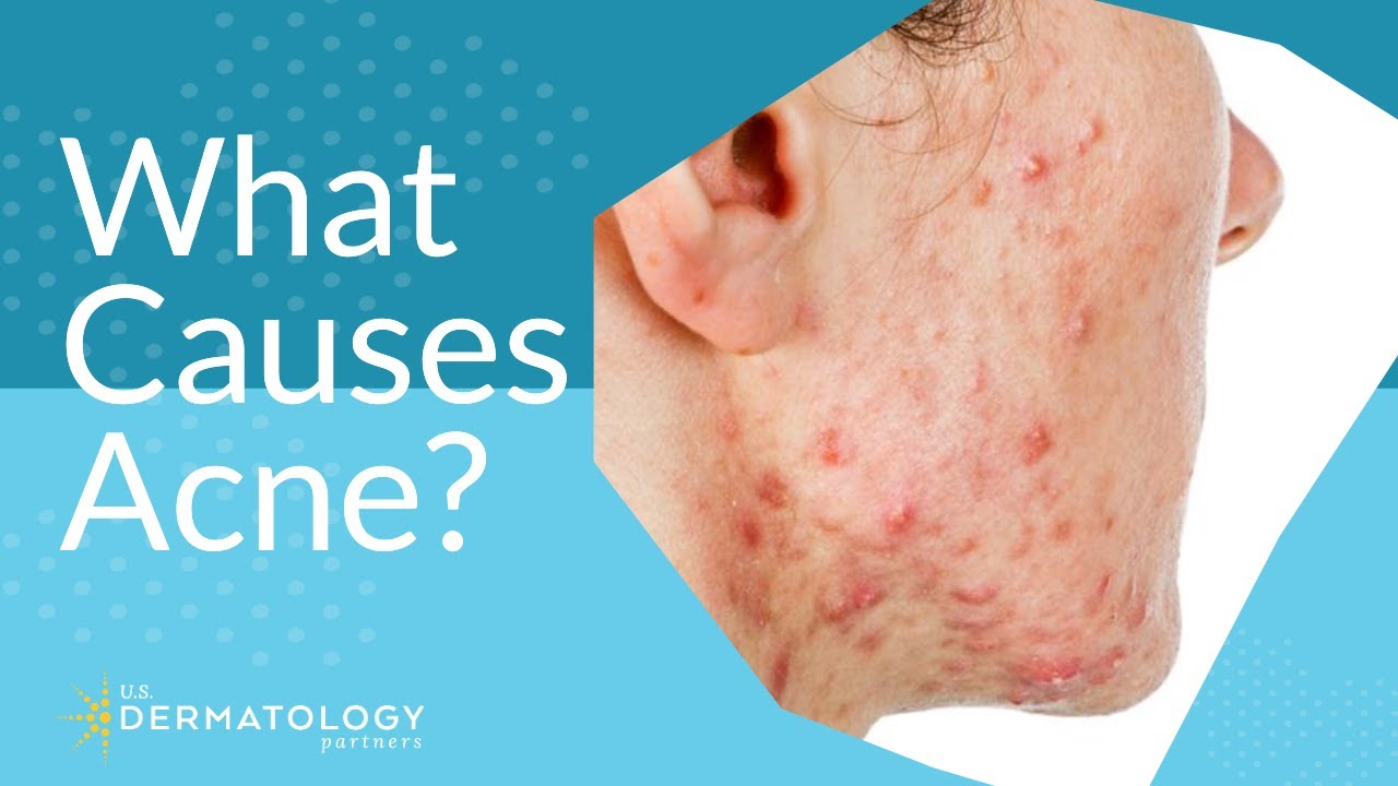 What Causes Acne? | Explained by Dermatologist
