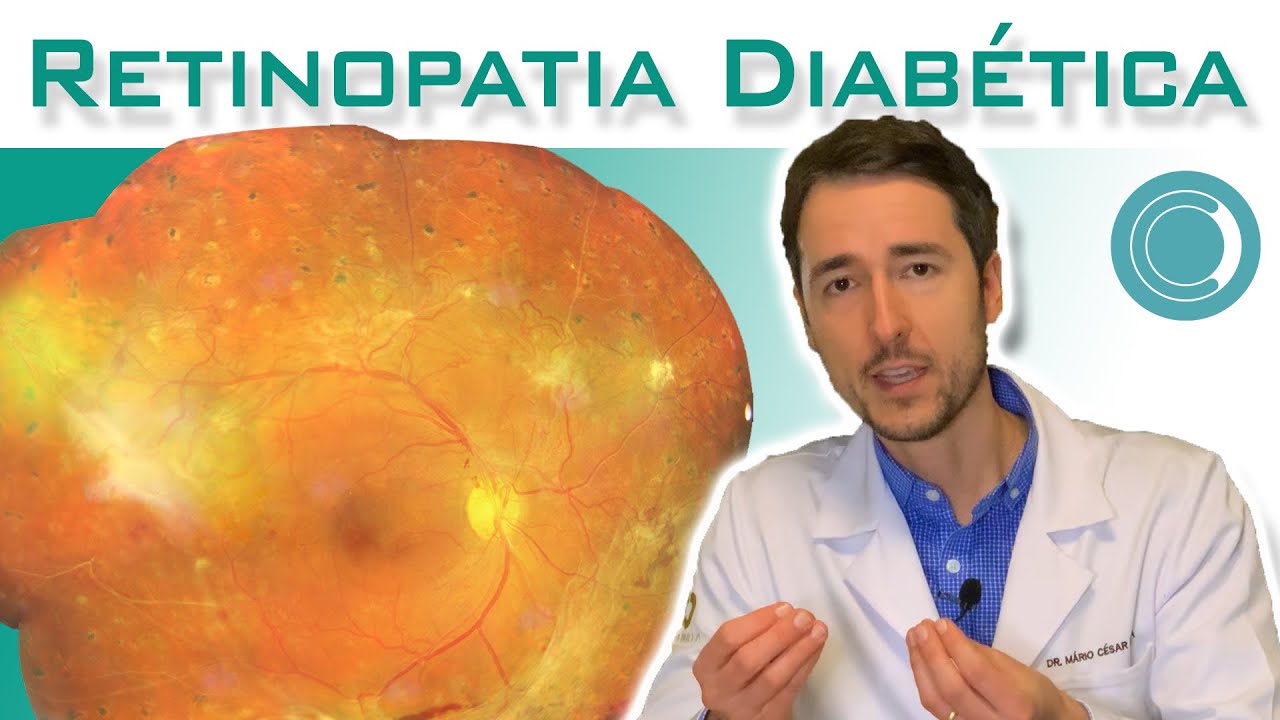 Retinopatia diabética - Sintomas e tratamento - Laser e injeção