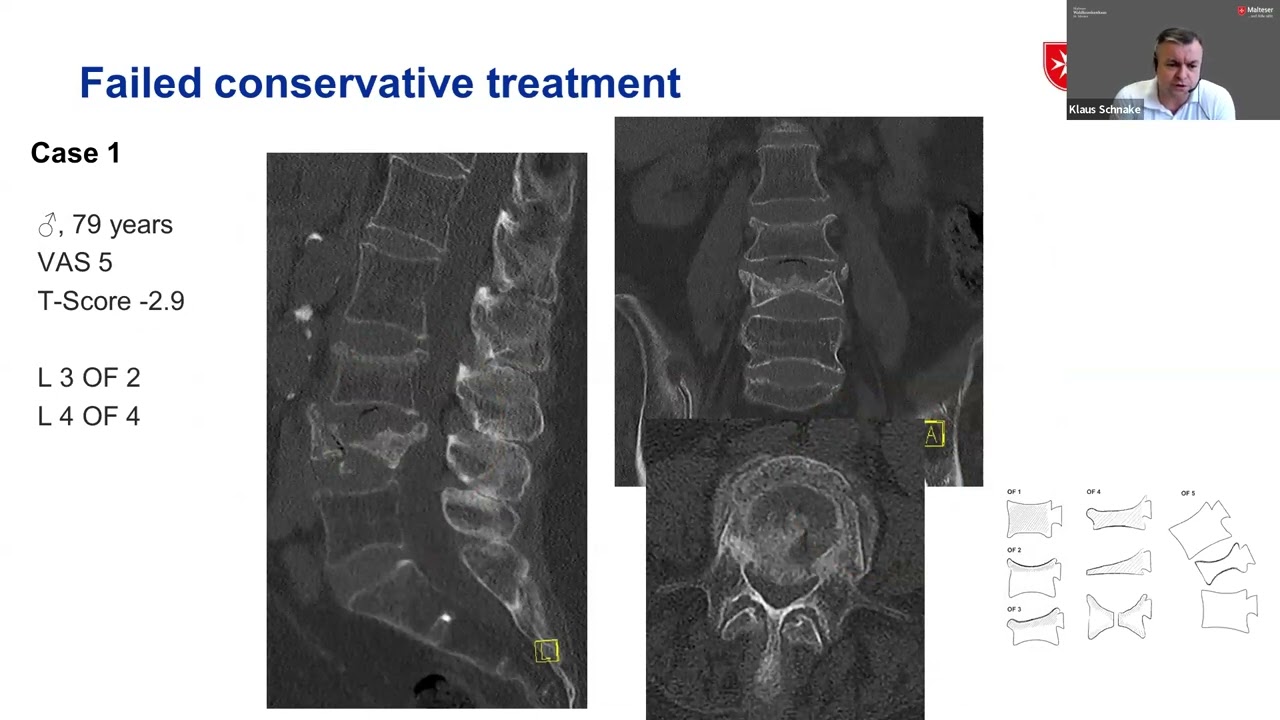 EANS Webinars: Fragility Fractures of the Spine — current treatment concepts