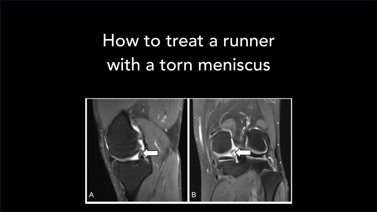 How to treat a runner with a torn meniscus