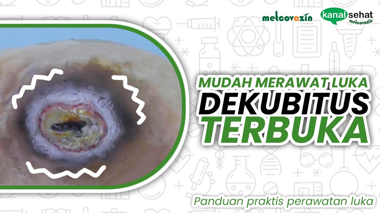 CARA MERAWAT LUKA DEKUBITUS TERBUKA | Kanal Sehat Metcovazin