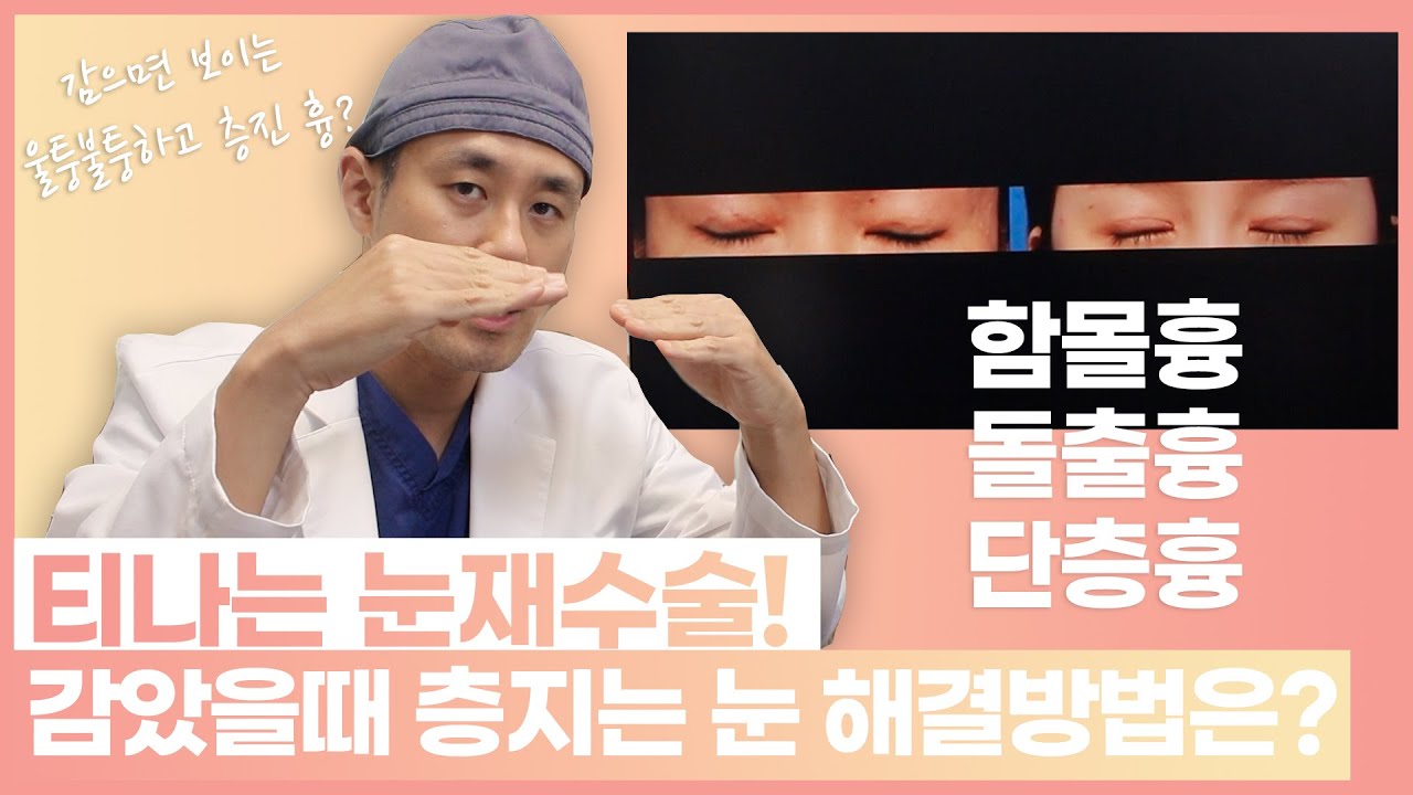 티나는 눈재수술  ( 함몰흉, 돌출흉, 단층흉) 해결 방법 (feat. 전후사진) # 쌍꺼풀재수술