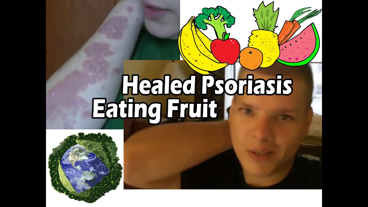 Heal Psoriasis Naturally - Raw &bull; Vegan &bull; Fruititarian &bull; Plant-Based Cure