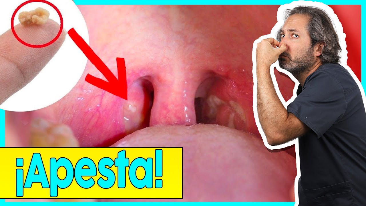 🚫&iexcl;EVITA los 𝗧𝗢𝗡𝗦𝗜𝗟𝗢𝗟𝗜𝗧𝗢𝗦! Como quitar esas 𝗔𝗣𝗘𝗦𝗧𝗢𝗦𝗔𝗦 BOLITAS BLANCAS en la garganta (🤮 MAL ALIENTO)