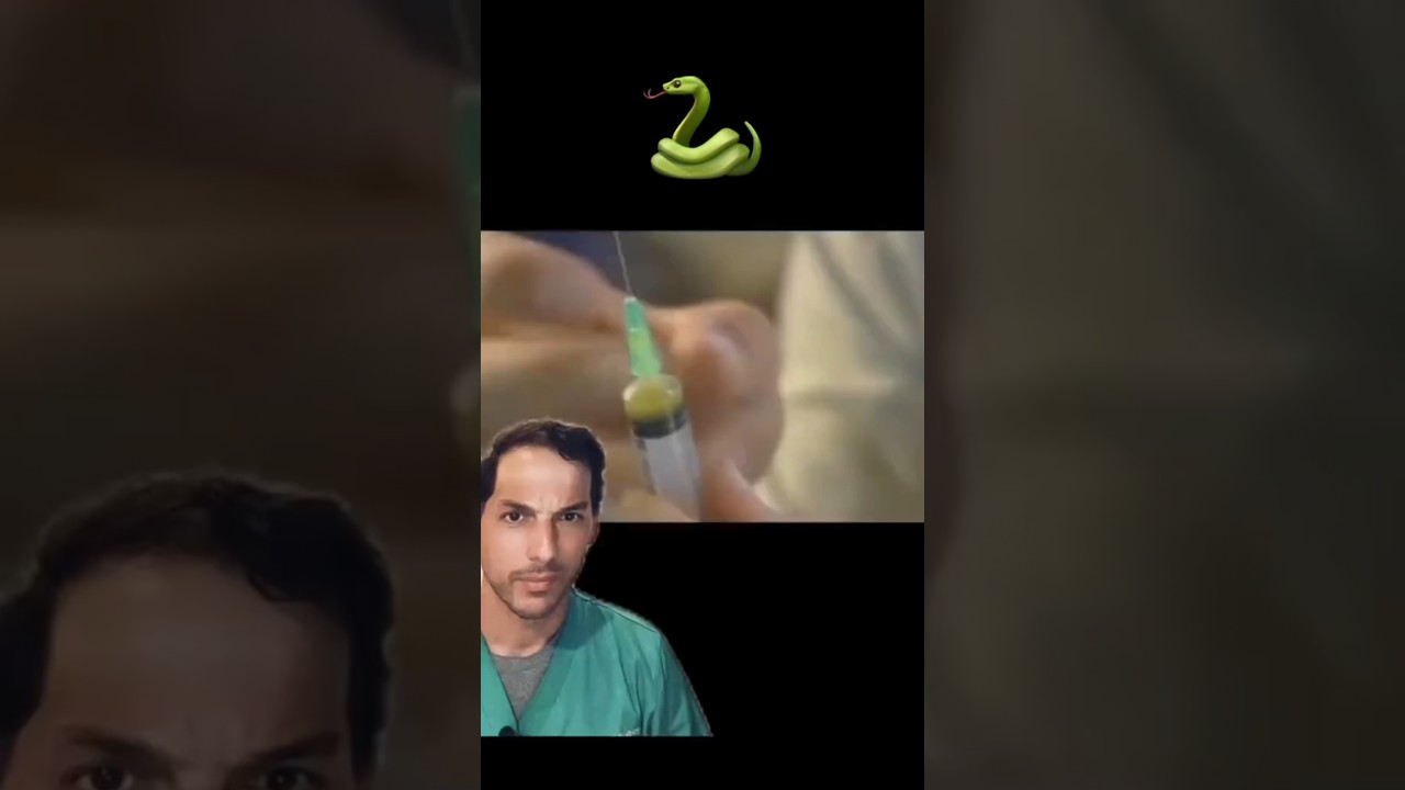 It's called disseminated intravascular coagulation #DIC #SnakeVenom #Venom #Snakebite #snake