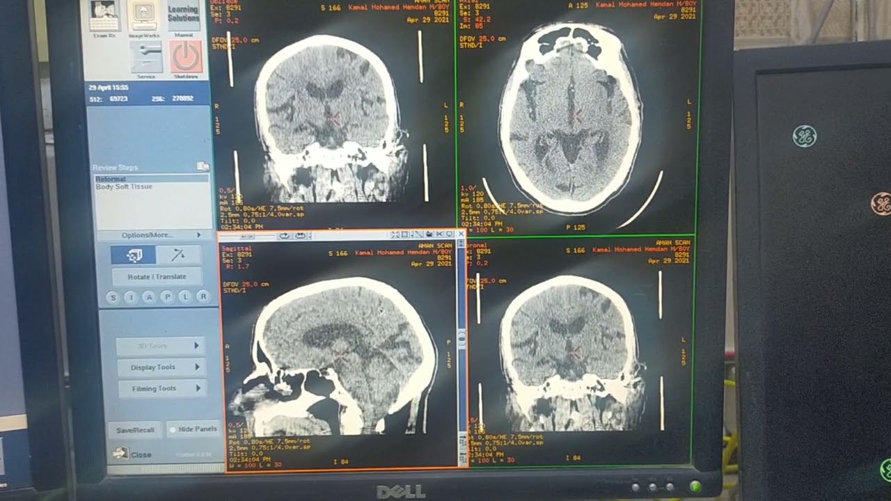الأشعة المقطعية علي المخ الجزء الاول  Ct Brain Part 1