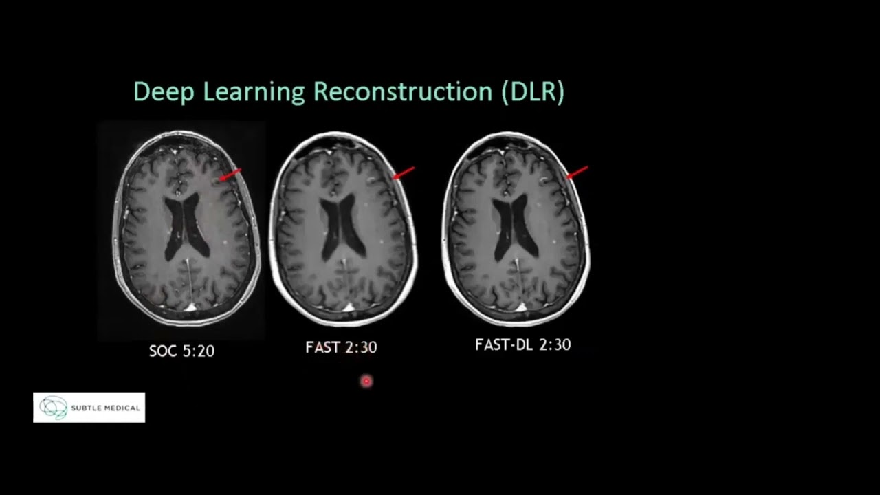 SubtleMR: Deep Learning Reconstruction, Compared to SOC - Suzie Bash, MD