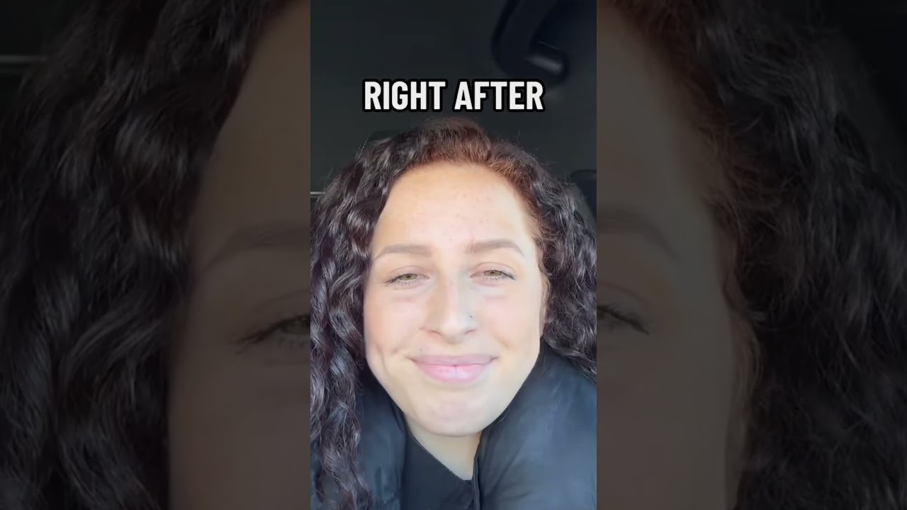 Botox treatment kick in after 5 days!