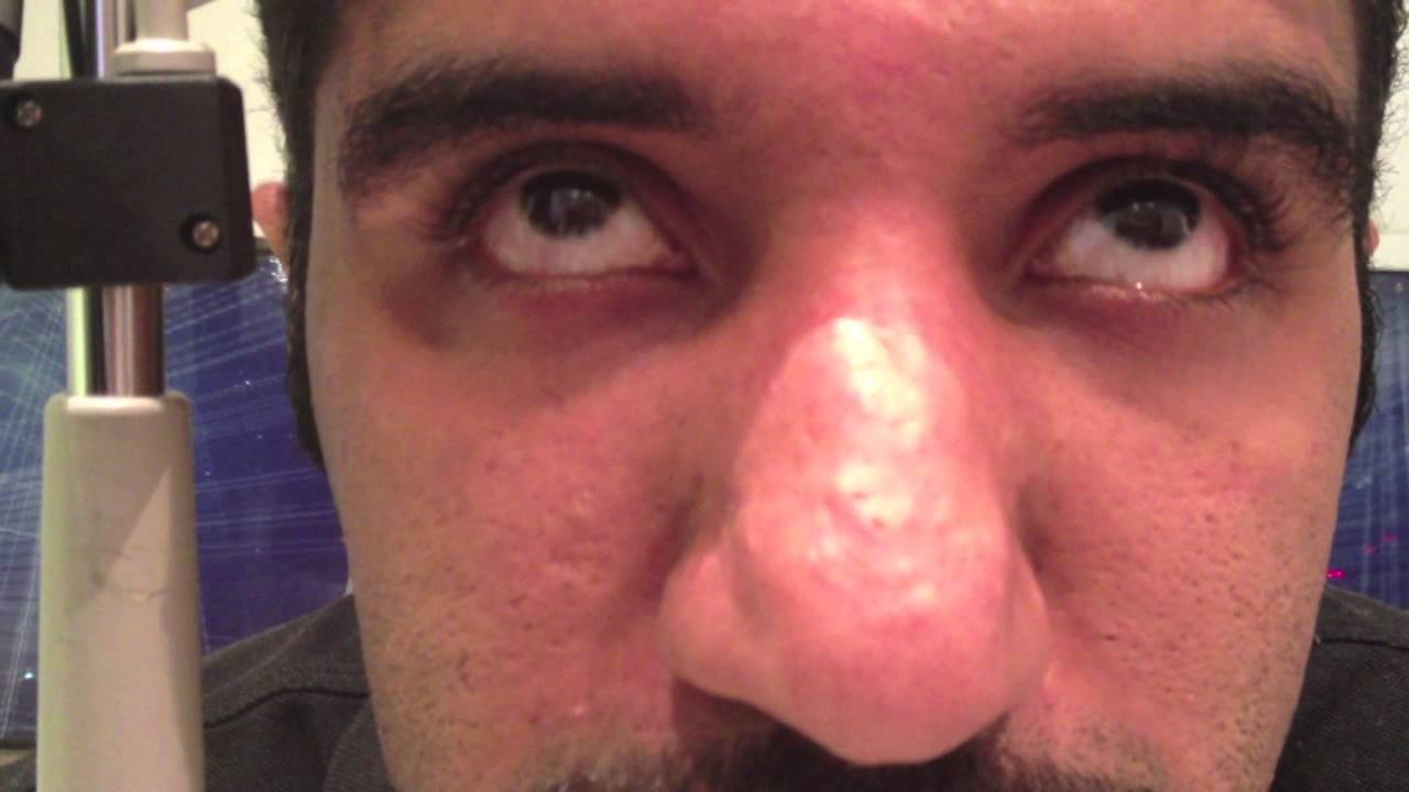 saccadic dysmetria