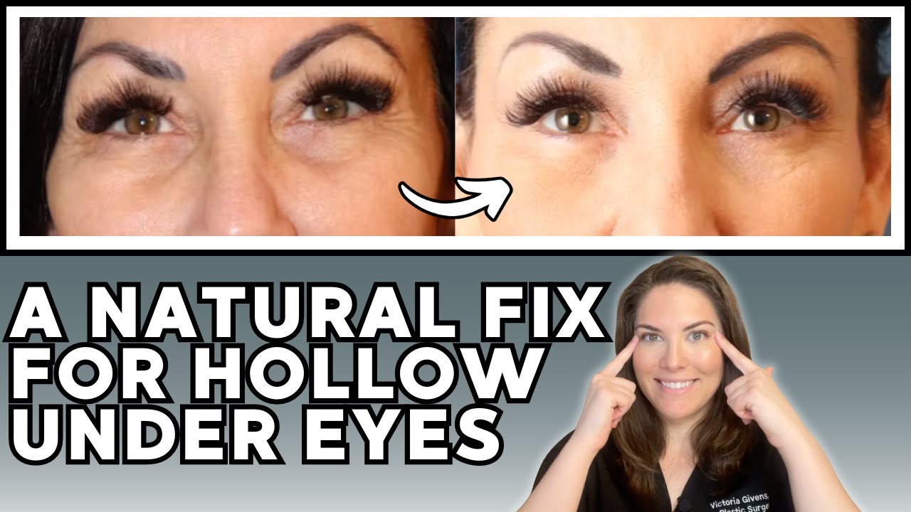 Ditch the Filler: A Natural Fix for Hollow Under Eyes